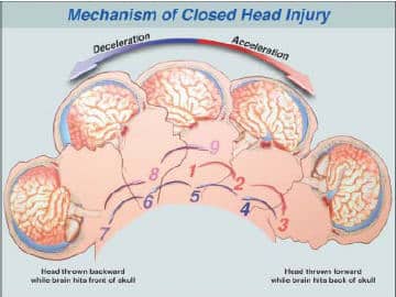 Injury head types of Head Injury: